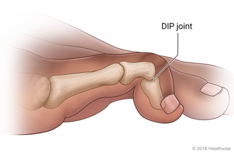 A mallet toe bent down at the joint near the tip of the toe A mallet toe bent down at the joint near the tip of the toe
