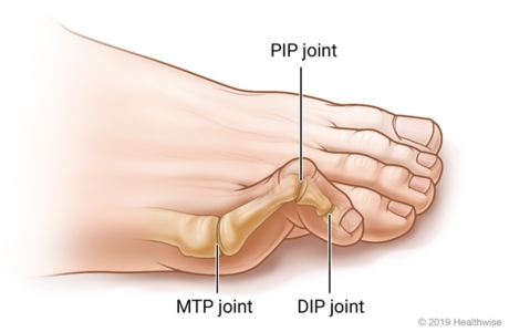 Hammer toe showing the middle toe joint bent up Hammer toe showing the middle toe joint bent up