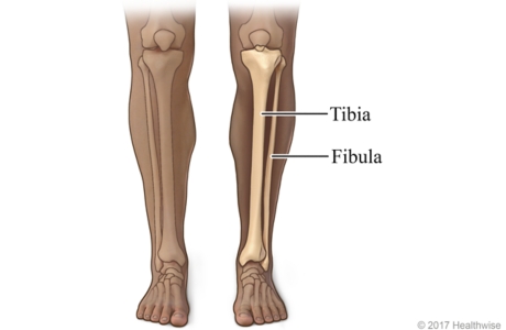 Skeletal view of bones of lower leg, the tibia, and fibula (shin bone)