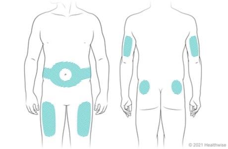 Locations on body for giving insulin shots, including on belly around navel, thighs, back of upper arms, and upper buttocks. Locations on body for giving insulin shots, including on belly around navel, thighs, back of upper arms, and upper buttocks.