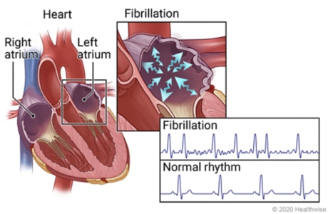 Right and left atria of heart with details showing fibrillation in an atrium, and EKG patterns of fibrillation and normal rhythm. Right and left atria of heart with details showing fibrillation in an atrium, and EKG patterns of fibrillation and normal rhythm.