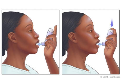 Person placing inhaler close to open mouth and pressing down on inhaler as they breathe in. Person placing inhaler close to open mouth and pressing down on inhaler as they breathe in.