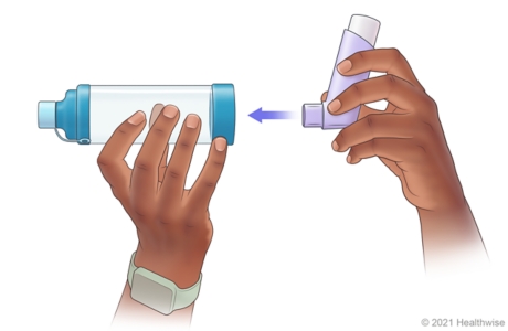 Person putting mouthpiece of meter-dose inhaler into end of spacer. Person putting mouthpiece of meter-dose inhaler into end of spacer.