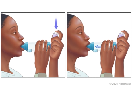 Person pressing down on inhaler to release medicine into spacer, then breathing in. Person pressing down on inhaler to release medicine into spacer, then breathing in.