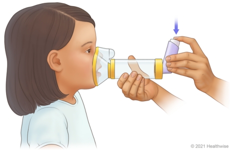 Adult holding mask spacer over child's nose and mouth, while pressing down on inhaler to release medicine into spacer. Adult holding mask spacer over child's nose and mouth, while pressing down on inhaler to release medicine into spacer.