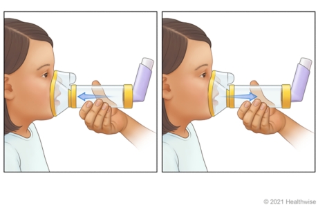Adult holding mask spacer over child's nose and mouth, while child breathes in medicine from spacer. Adult holding mask spacer over child's nose and mouth, while child breathes in medicine from spacer.