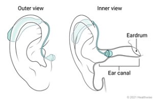Outer and inner view of mini BTE hearing aid placed in ear. Outer and inner view of mini BTE hearing aid placed in ear.