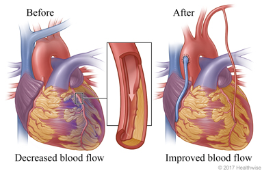 Decreased blood flow caused by narrowed or blocked artery before surgery and improved blood flow after surgery. Decreased blood flow caused by narrowed or blocked artery before surgery and improved blood flow after surgery.