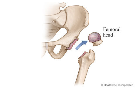 Hip replacement: Damaged cartilage and bone are removed. Hip replacement: Damaged cartilage and bone are removed.