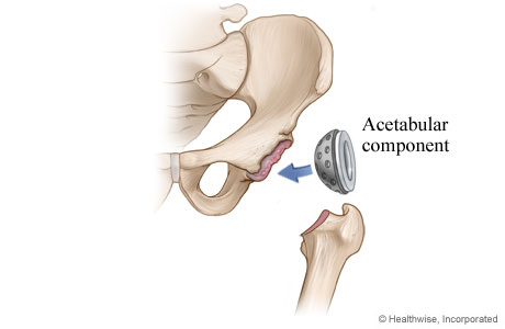Hip replacement: Hip socket component is placed. Hip replacement: Hip socket component is placed.
