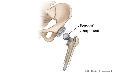 Hip replacement: Femoral component is placed. Hip replacement: Femoral component is placed.