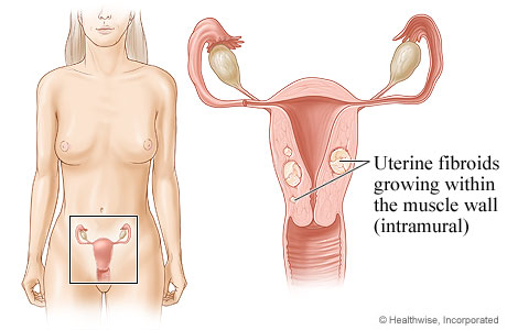 Location of uterus and ovaries, with detail of fibroid growing in uterine wall.