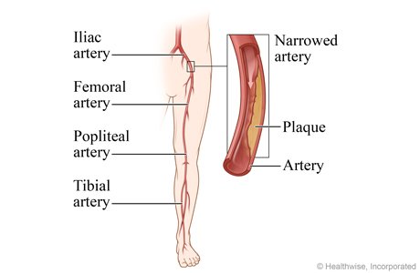 Peripheral arteries of the leg, with detail of the iliac artery narrowed by plaque Peripheral arteries of the leg, with detail of the iliac artery narrowed by plaque