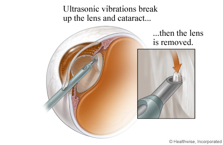 Cataract being broken up using ultrasound and removed using suction. Cataract being broken up using ultrasound and removed using suction.