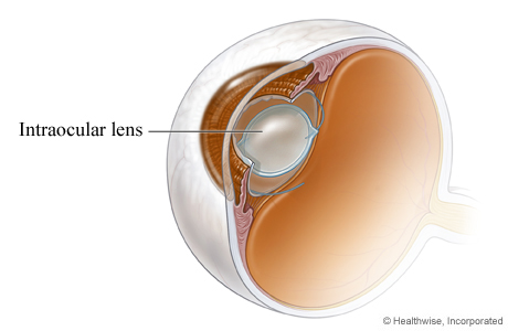 An intraocular lens in place after cataract surgery. An intraocular lens in place after cataract surgery.