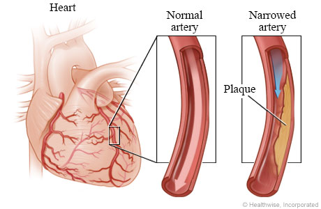 Normal coronary artery and artery narrowed by plaque. Normal coronary artery and artery narrowed by plaque.