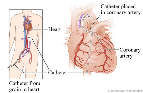 Catheter going from groin to heart, with detail of catheter in a coronary artery. Catheter going from groin to heart, with detail of catheter in a coronary artery.