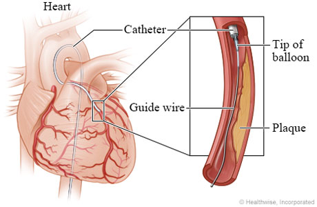 Guide wire and tip of balloon in narrowed artery. Guide wire and tip of balloon in narrowed artery.