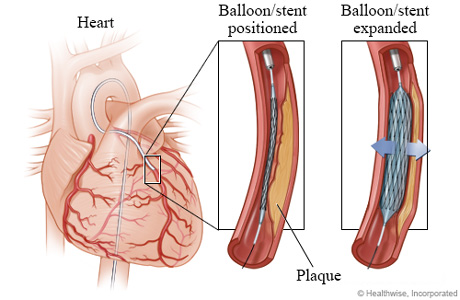 Balloon and stent positioned and expanded. Balloon and stent positioned and expanded.
