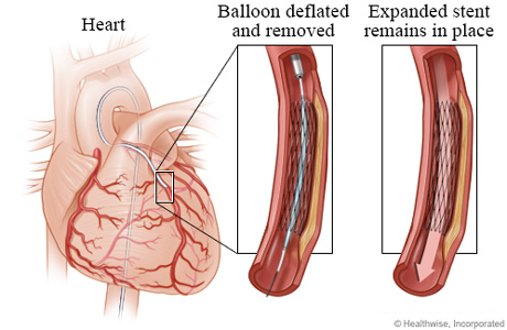 Deflated balloon leaving an expanded stent in place. Deflated balloon leaving an expanded stent in place.