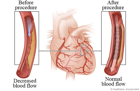 Decreased blood flow caused by narrowed artery before angioplasty compared to normal blood flow after angioplasty. Decreased blood flow caused by narrowed artery before angioplasty compared to normal blood flow after angioplasty.