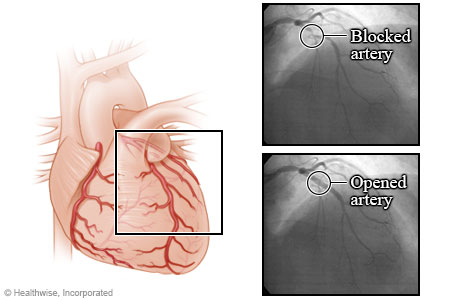 Arteries before and after an angioplasty. Arteries before and after an angioplasty.