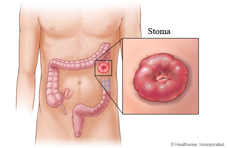 A stoma created after colon surgery A stoma created after colon surgery