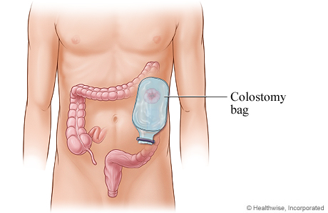 A colostomy bag positioned on the stoma A colostomy bag positioned on the stoma