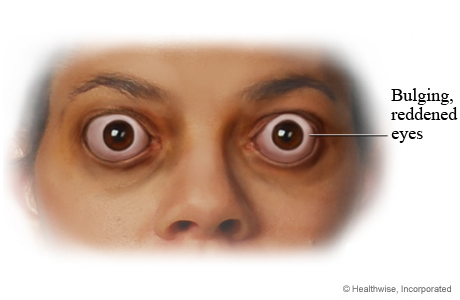 The bulging red eyes caused by Graves' ophthalmopathy