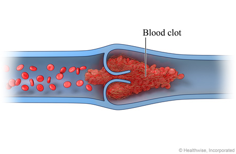 Normal venous blood flow (cross-section) Normal venous blood flow (cross-section)