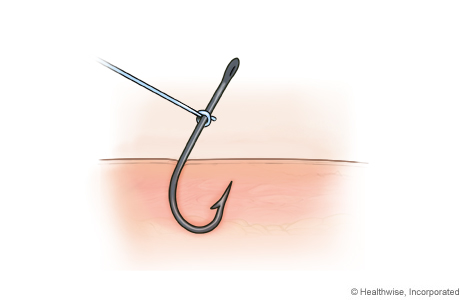 String-pull method for removing a fish hook, step A: Tie a piece of string to the hook String-pull method for removing a fish hook, step A: Tie a piece of string to the hook