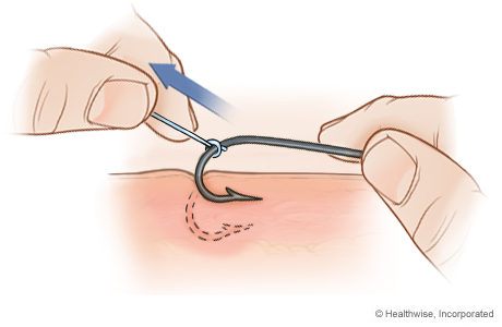 Step C: Jerk string to pull barb out Step C: Jerk string to pull barb out