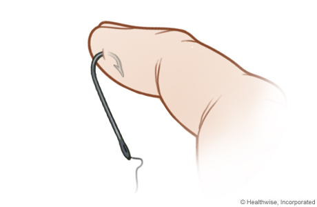 Alternate method of fish hook removal, step A Alternate method of fish hook removal, step A