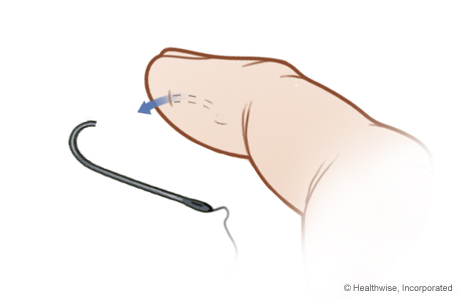 Step D: Remove the hook Step D: Remove the hook