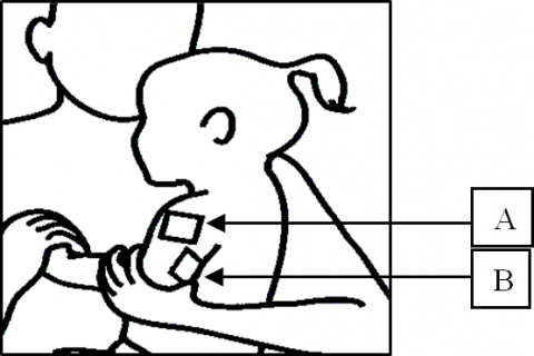 A drawing of areas to apply numbing cream on a child's arm