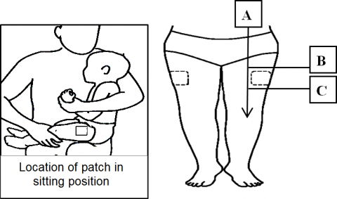 Image of a child sitting with patches showing where to apply numbing cream.