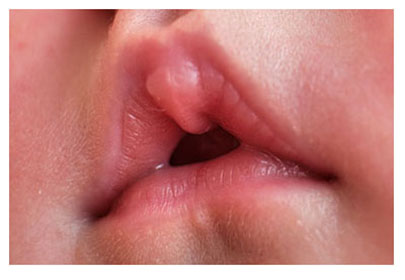 baby open mouth posture, u-shaped upper lip and lip blister